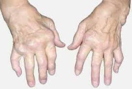 Gout