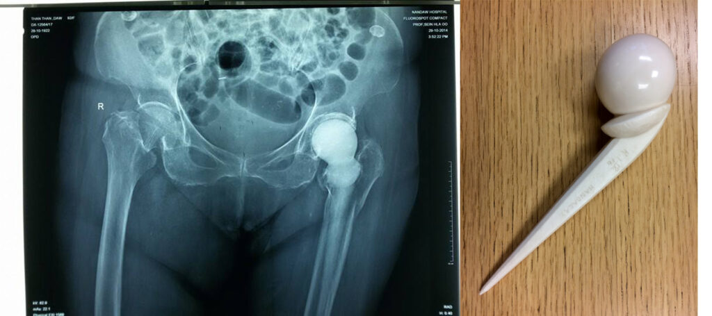 Thoughts Relating to the San Baw Lecture on Orthopaedic Innovation at the University of Pennsylvania