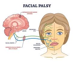 မျက်နှာတစ်ခြမ်းရွဲ့သွားခြင်း (Facial Palsy)