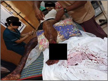 Innocent Civilians Injured in Explosion of Device Planted by So-called PDF Faction  in Palaw Township of Tanintharyi Region.