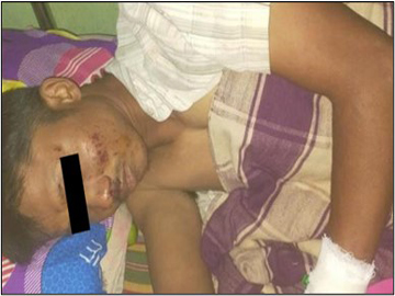 People’s Militia Member Injured After Stepping Explosive Device Planted by So-Called PDF Terrorist Group in Pauk Township of Magway Region