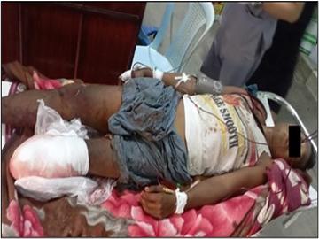 Innocent Civilian Injured After Stepping Explosive Device Planted by Terrorist Group in Natogyi Township of Mandalay Region