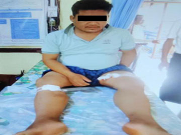 An innocent civilian was injured in explosions caused by two explosive devices planted by a so-called PDF terrorist group in Gangaw Township of Magway Region.