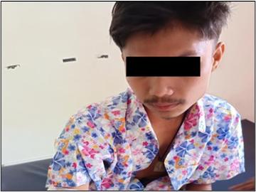 An innocent civilian injured in an attack by a so-called PDF terrorist group  in Tanintharyi Township of Tanintharyi Region.