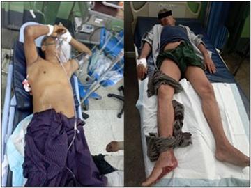 Six innocent civilians, including a child, injured in terrorist attacks by so-called PDF terrorists  in Madaya Township of Mandalay Region.
