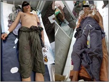 Six innocent civilians, including a child, injured in terrorist attacks by so-called PDF terrorists  in Madaya Township of Mandalay Region.