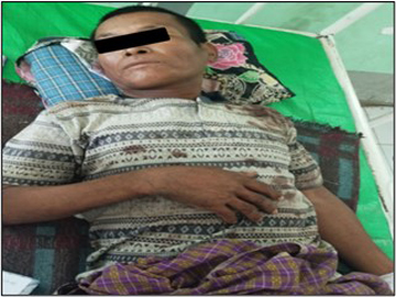 Two innocent civilians were injured by improvised explosive device planted by so-called PDF terrorist group in Pwintphyu Township of Magway Region.