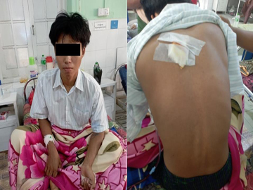 Innocent Civilian Injured in Attack by So-Called PDF Terrorists in Monywa Township of Sagaing Region
