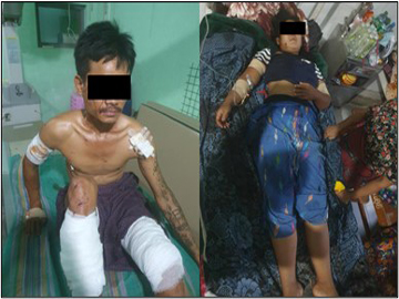Two innocent civilians were injured after stepping on an explosive device planted by a so-called PDF terrorist group in Shwebo Township of Sagaing Region.