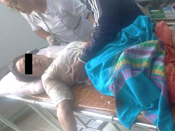 Innocent Civilian Injured After Stepping Explosive Device Planted by Terrorist Group in Loikaw Township of Kayah State