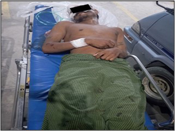An innocent civilian injured in a heavy weapon attack by a so-called PDF terrorist group in Shwebo Township of Sagaing Region.