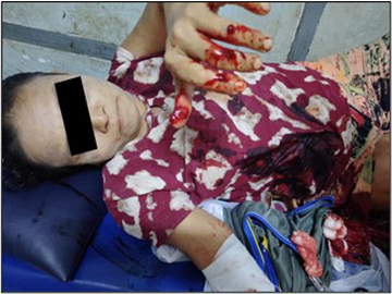 Three innocent civilians injured in a heavy weapon attack by pro-terrorism KNU members and so-called PDF terrorists in Kawkareik Township of Kayin State.