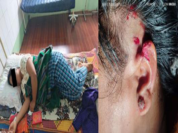 Primary Assistant Teacher Injured in Attack by So-Called PDF Terrorist Group in Mahlaing Township of Mandalay Region