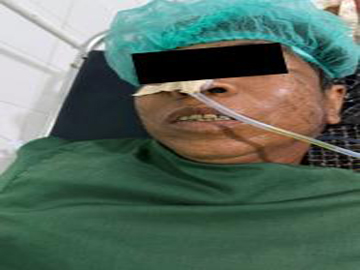 Three innocent civilians injured in heavy weapon attacks by Ta’ang National Liberation Army (TNLA) terrorist group in Kyaukme and Naungcho Townships of Shan State.