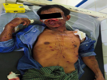 An innocent civilian injured after stepping on a land mine planted by a so-called  PDF terrorist group in Salin Township of Magway Region.