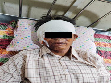 An innocent civilian was injured by explosive device planted by a so-called  PDF terrorist group in Phyu Township of Bago Region.