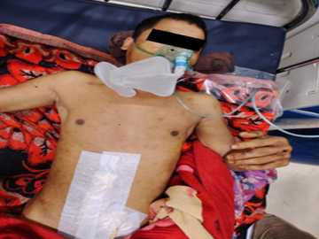 An innocent civilian injured in a heavy weapon attack by a combined group of Ta’ang National Liberation Army (TNLA) terrorists and so-called PDF terrorists in Nyaungcho Township of Shan State.