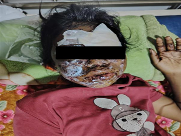 An innocent civilian injured by explosive device planted by a pro-terrorism armed insurgent group in Hsipaw Township of Shan State.