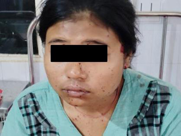Two innocent civilians injured after stepping on an explosive device planted by a terrorist group in Nyaung-U Township of Mandalay Region.