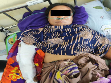 An innocent civilian injured in a heavy weapon attack by a pro-terrorism armed insurgent group in Pekon Township of Shan State.