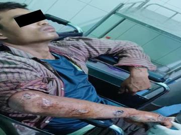 An innocent civilian injured in a heavy weapon attack by Ta’ang National Liberation Army (TNLA) terrorist group in Naungcho Township of Shan State.