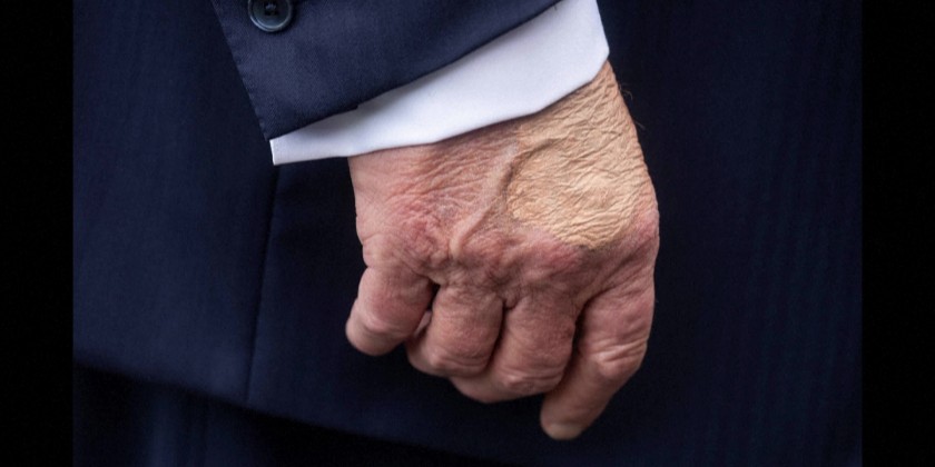 Bruising on US President Trump's right hand