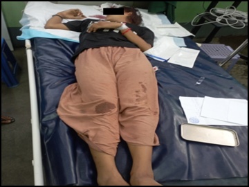 An innocent civilian injured in an attack by so-called PDF terrorists in Sagaing Township of Sagaing Region.