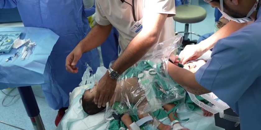 Saudi Conjoined Twins Program achieves a new medical milestone