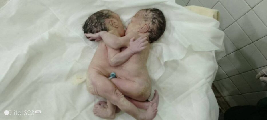 Bilin Hospital delivers conjoined twins by Caesarean Section