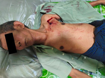 Innocent Civilian Injured in Heavy Weapon Attack by So-Called PDF Terrorist Group in Kyauktaga Township of Bago Region