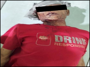 Two Innocent Civilians Injured in Heavy Weapon Attacks by Ta’ang National Liberation Army (TNLA) Terrorist Group in Naungcho Township of Northern Shan State