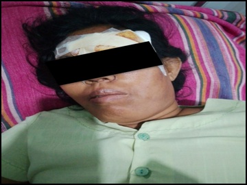 Innocent Civilian Injured in Heavy Weapon Attacks by So-Called PDF Terrorist Group in Taungtha Township of Mandalay Region