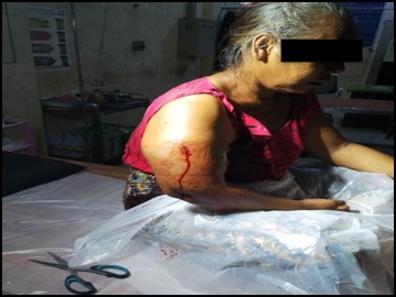 Innocent Civilian Injured in Heavy Weapon Attack by So-Called PDF Terrorist Group in Yebyu Township of Tanintharyi Region