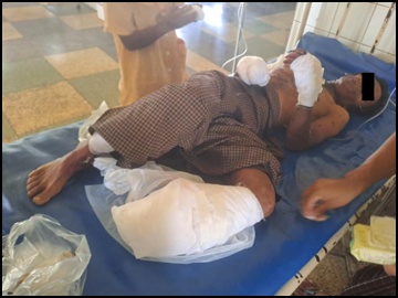 Innocent Civilian Injured After Stepping Explosive Device Planted by So-Called PDF Terrorist Group in Lashio Township of Shan State