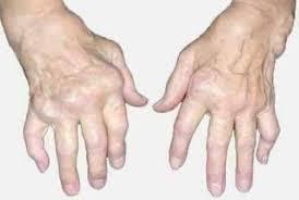 Gout