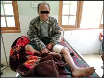 A man injured by gunfire near U-yin Village, Nyaung-U Township of Mandalay Region