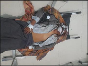 A man injured by an explosion near Gway Pin Lay Village in Chauk Township of Magway Region.