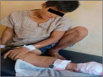 A woman injured in an explosion near Kyar Inn Village in Hpa-an Township, Kayin Region.