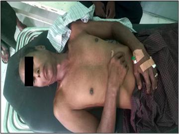Innocent Civilians Injured in Explosion of Device Planted by So-called PDF Faction in Palaw Township of Tanintharyi Region.