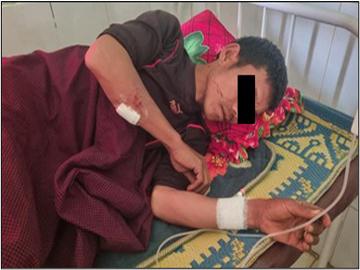 Innocent Civilian Wounded in Explosion Caused by Terrorist-Planted Device in Hsihseng Township of Southern Shan State.