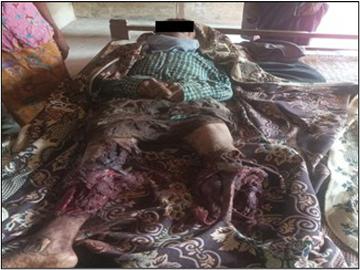 Innocent Civilian Killed After Stepping on Explosive Device Planted by So-called PDF terrorist Faction in Aung Taw Mu Ward, Pauk Township of Magway Region.