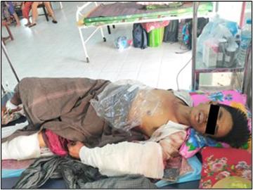 Two Innocent Civilians Injured in Mortar Attack by Armed Terrorists in Yebyu Township of Tanintharyi Region.