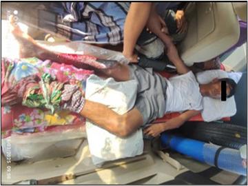 An Innocent Civilian Sustained Shrapnel Injuries After Stepping on Explosive Device Planted by So-called PDF terrorist Faction in Myeik Township of Tanintharyi Region.