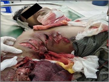 Innocent Civilian Injured After Triggering Explosive Device Planted by So-called PDF Terrorist Faction in Pakokku Township of Magway Region