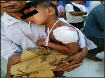 Child Injured in Heavy Weapon Attack by Terrorists in Patheingyi Township of Mandalay Region