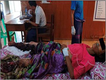 Innocent Civilian Injured After Stepping on Explosive Device Planted by So-called PDF Faction in Palaw Township of Tanintharyi Region.