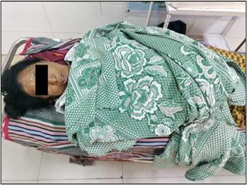 Innocent Civilian Injured in Heavy Weapon Attack by Terrorists in Tada-U Township of Mandalay Region.