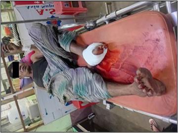 Innocent Civilian Injured After Stepping on Explosive Device Planted by Terrorist Faction in Hpa-an Township of Kayin State.