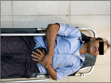 Innocent Civilian Injured After Stepping on Explosive Device Planted by Terrorist Faction in Sagaing Township of Sagaing Region.