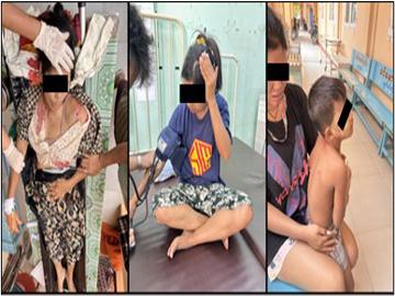 Five Innocent Civilians and a Child Injured in Heavy Weapon Attack by Terrorists in Shwebo Township of Sagaing Region.